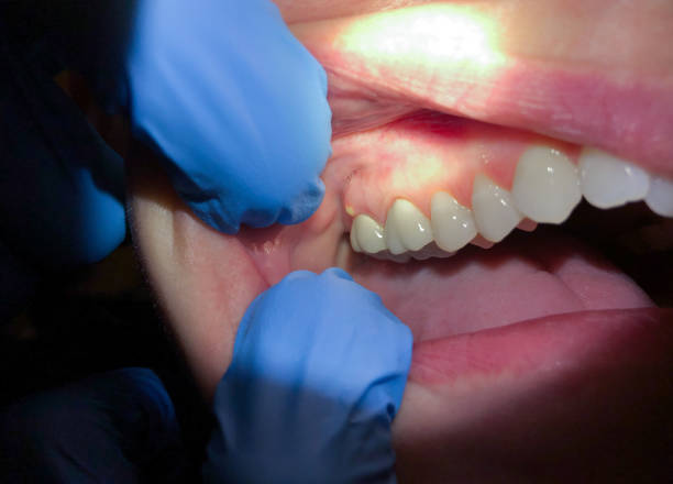 Best Dentist for Tooth Abscess  in Brentwood, MO